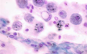 Science Immunology:巨噬細(xì)胞發(fā)育缺陷導(dǎo)致肺部疾病